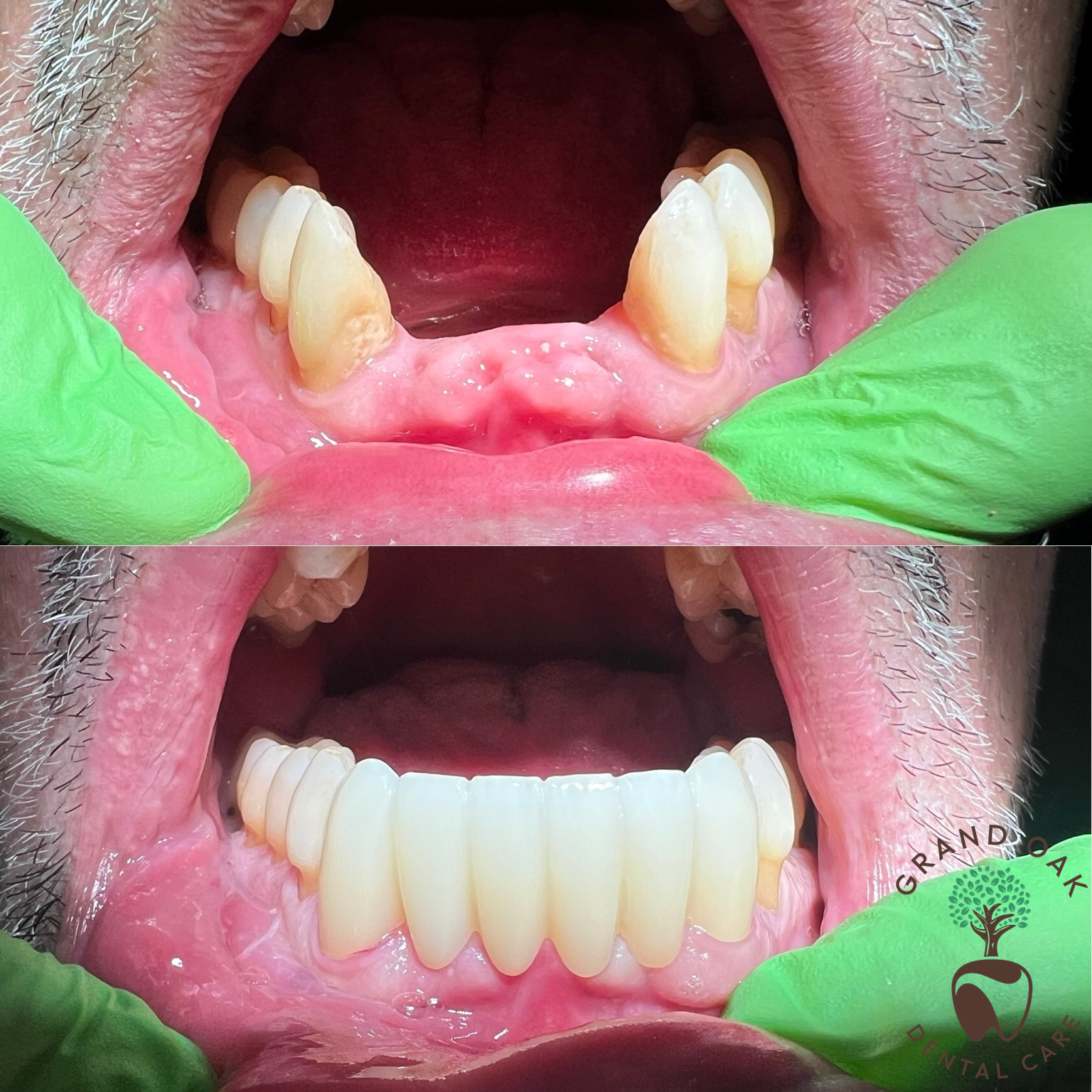 A Whole New Set of Lower Teeth